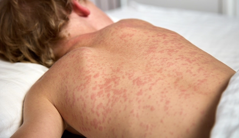 Epidemija ospica poharala Teksas: Preminulo jedno dijete, 20 osoba ima ozbiljne komplikacije